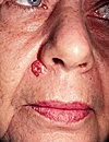Nodular BCC