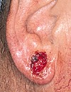 ulcerated BCC ear