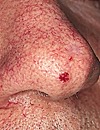 Ulcerated BCC nose