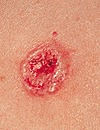 Ulcerated Basal Cell Carcinoma