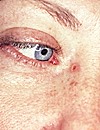 BCC nose